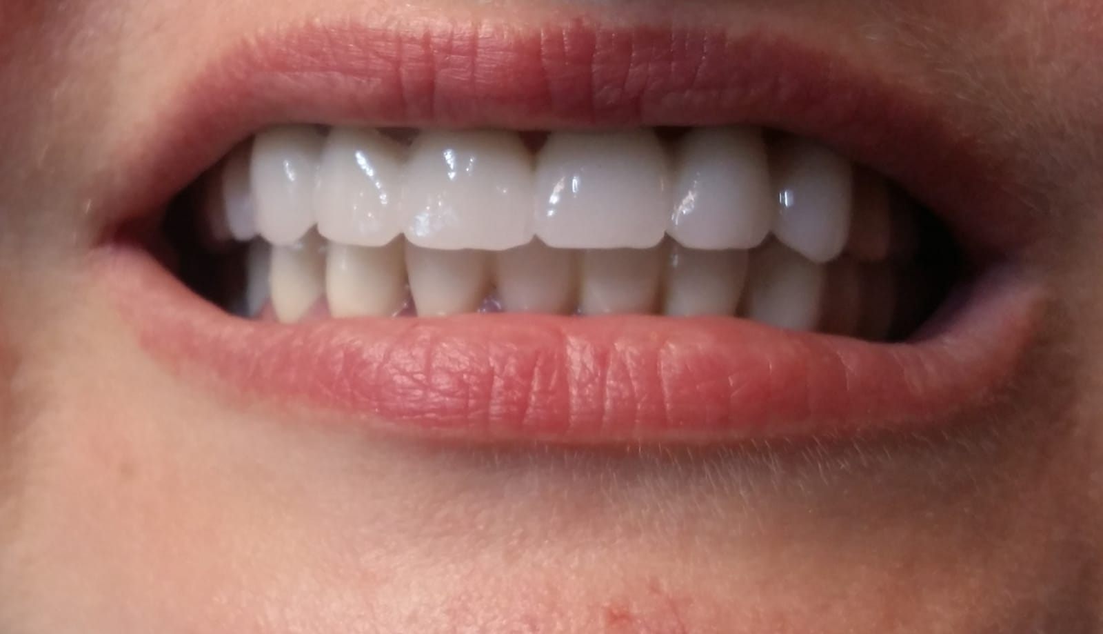 Servicii tehnica dentara Preturi proteze dentare